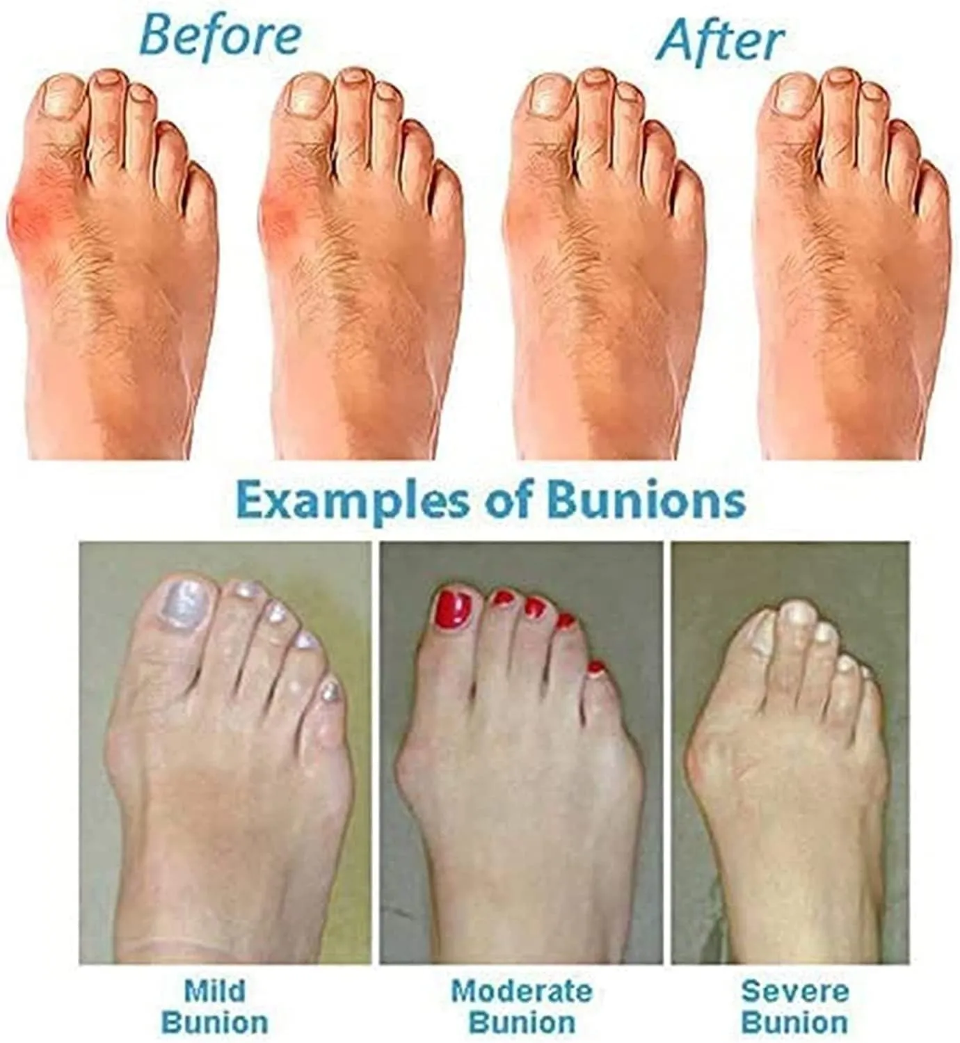 Fashion Split Toe Bunion Corrector Sandals Men, Non-Slip Orthotic Leather Men's Sandals Bunion Relief